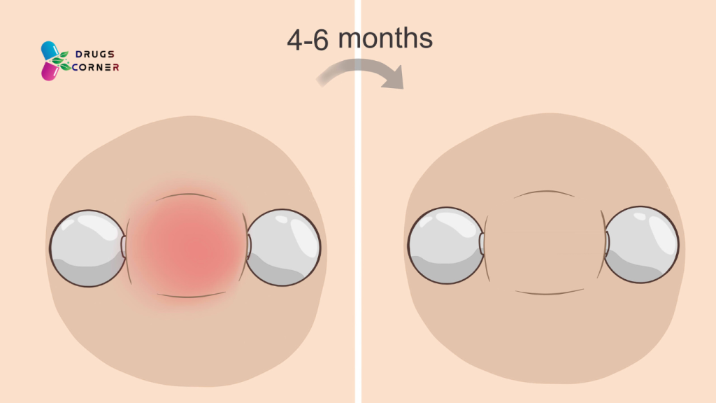 What is Nipple Piercing? When Can I Change My Nipple Piercing?
